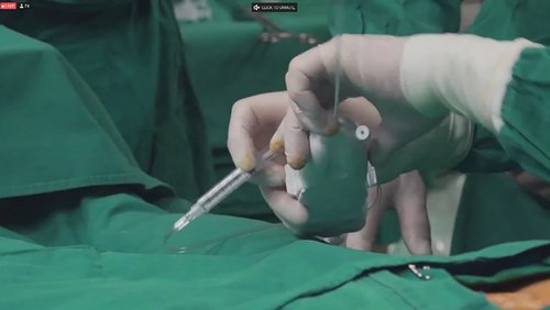Nemački i srpski lekari izveli jedinstvenu intervenciju uklanjanja bola u kičmi