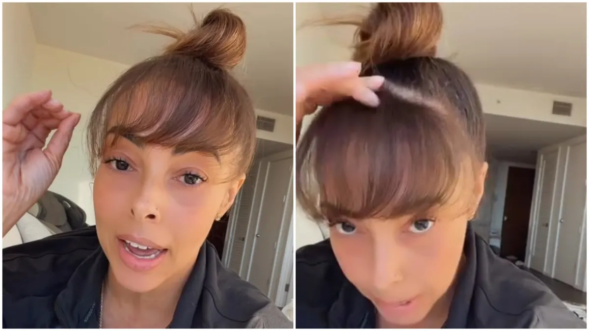 Otišla je na transplantaciju kose, pa ubrzo otkrila šokantnu nuspojavu koja je zbunila i hirurga: "Ovo se nikad pre nije desilo"