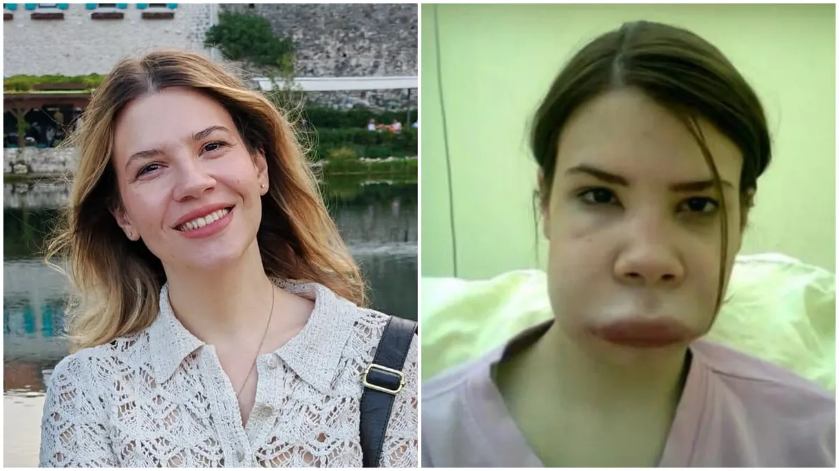 Jovana je 20 godina mislila da pati od alergije, a onda je saznala da ima redak sindrom zbog kog nekontrolisano otiče: Napad može da izazove i prevelika sreća