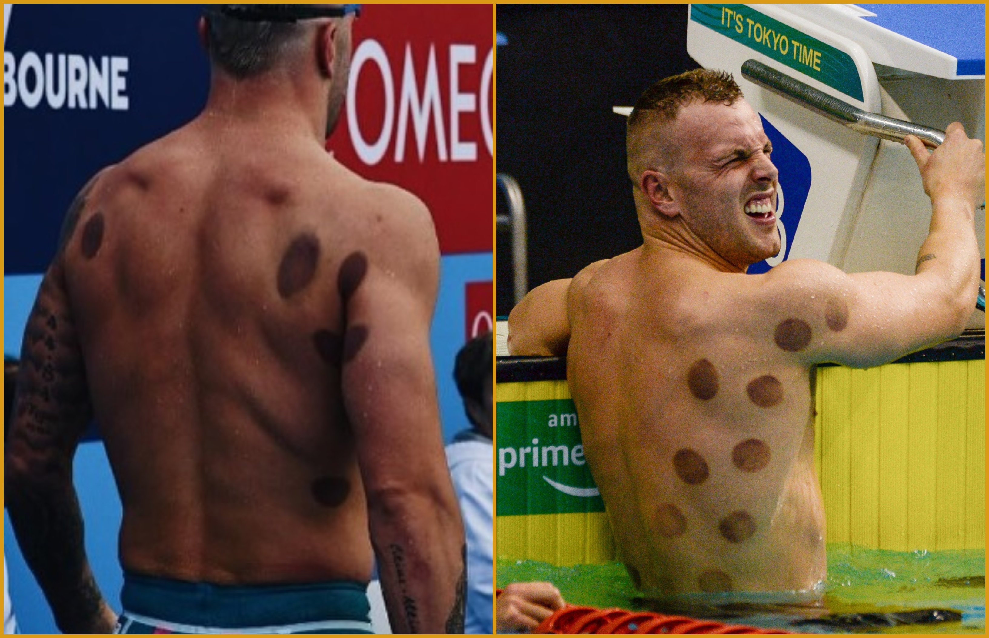 Zašto sportisti imaju crne tragove na leđima