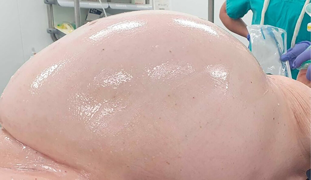 U Gospiću iz pacijentice izvadili tumor od 20 kilograma