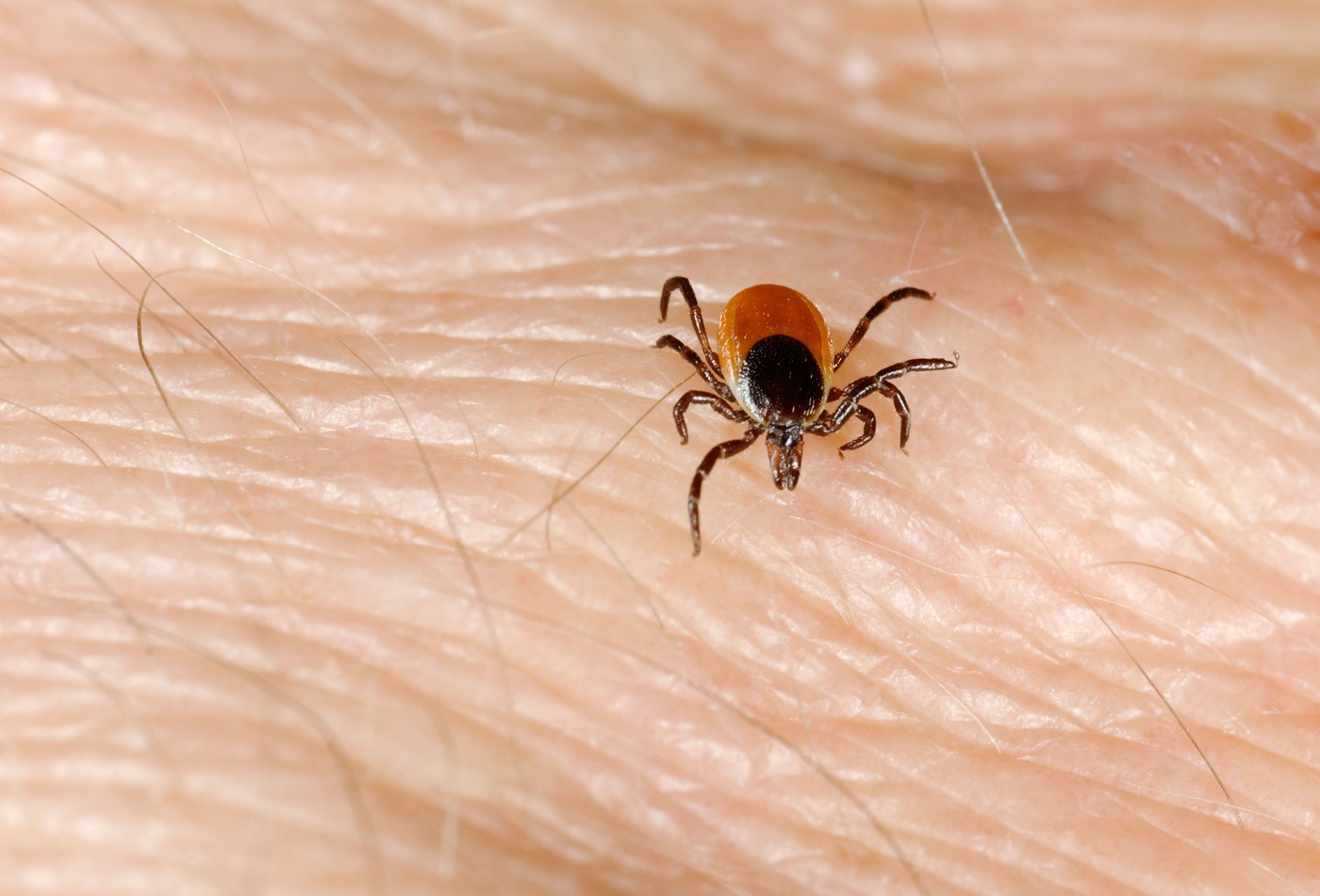 Ixodes scapularis deer tick on human skin,Image: 13385287, License: Rights-managed, Restrictions: , Model Release: no, Credit line: Scott Camazine / Alamy / Profimedia