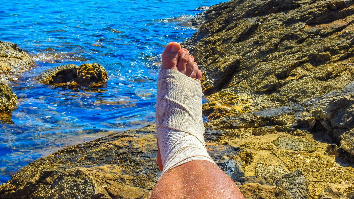 Foot injury, broken leg wrapped in a bandage while on vacation, bicycle accident and broken bones on vacation