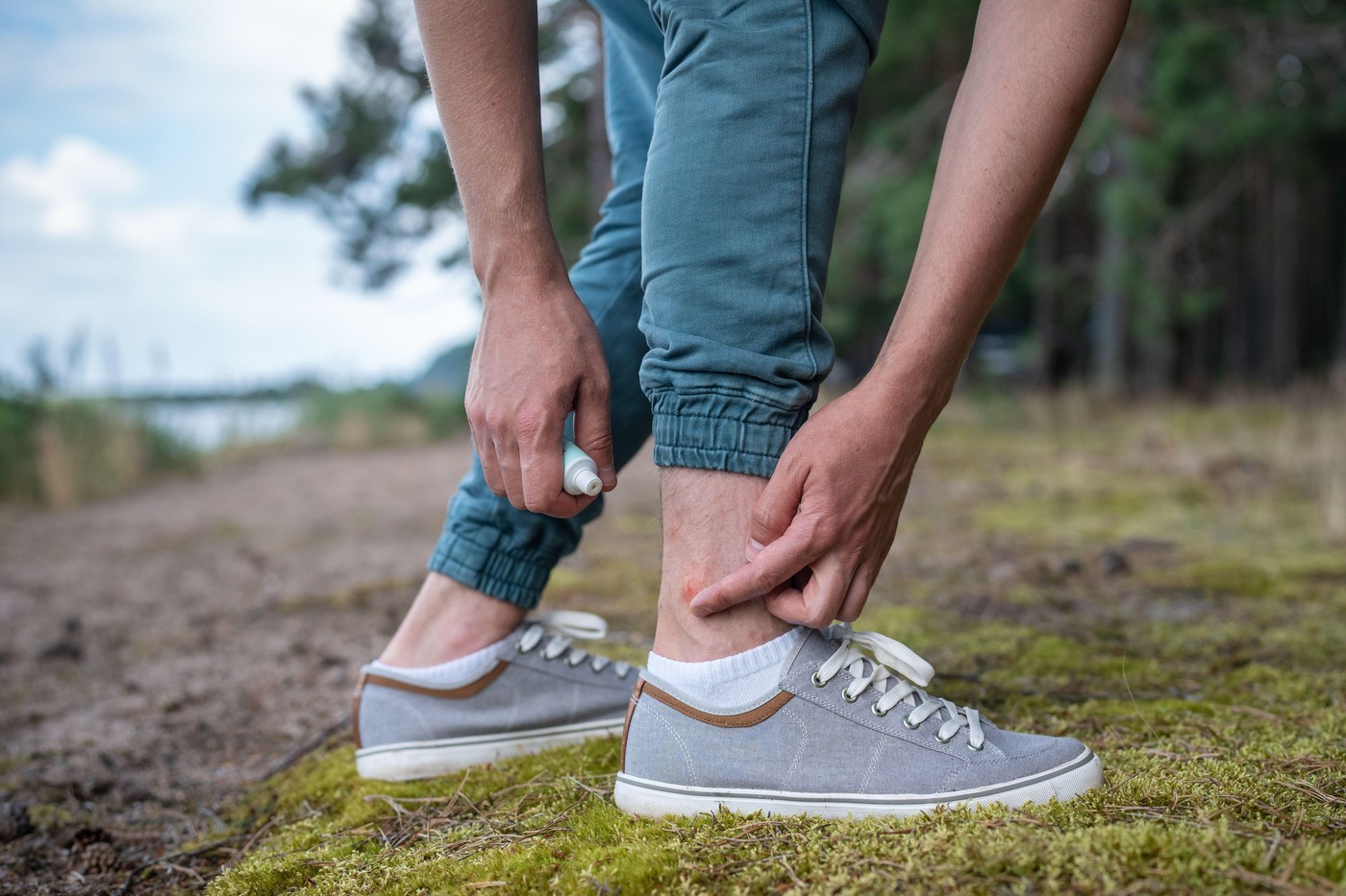 Man with mosquitoes bites itching leg, applying balm on swell skin, suffering from allergic reaction