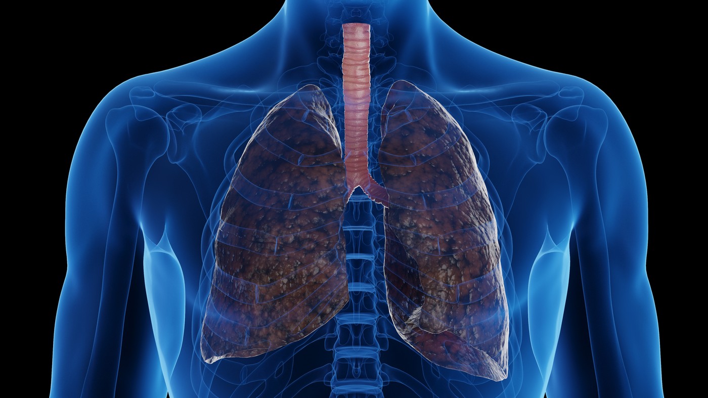 Smoker's lungs, illustration.,Image: 972368889, License: Royalty-free, Restrictions: , Model Release: no, Credit line: 3DMEDISPHERE / Sciencephoto / Profimedia