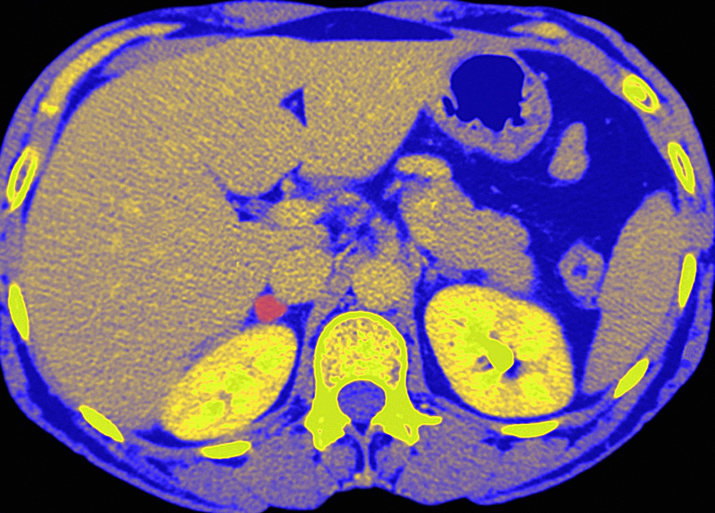 Adrenal gland tumour, CT scan