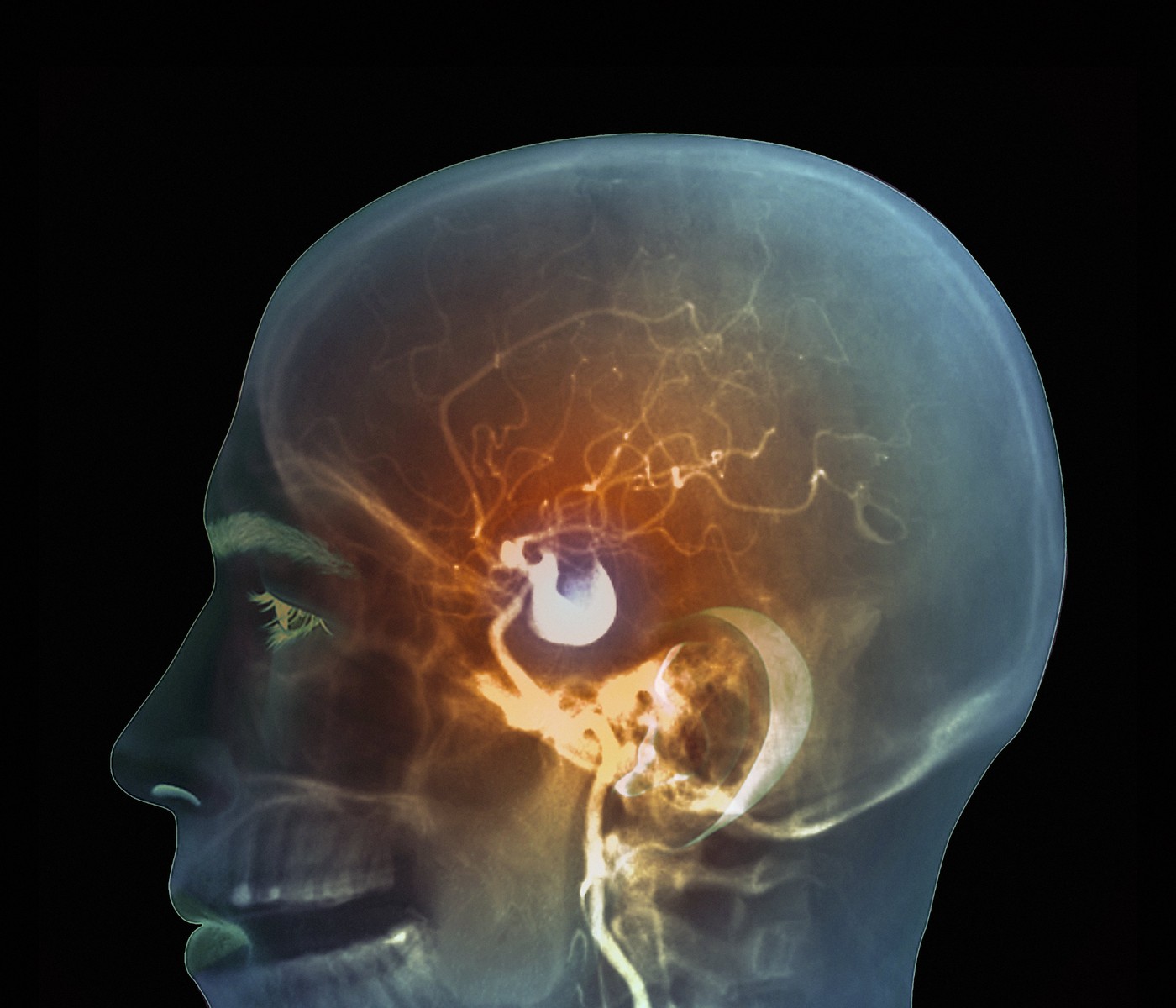 Brain aneurysm, DSA scan