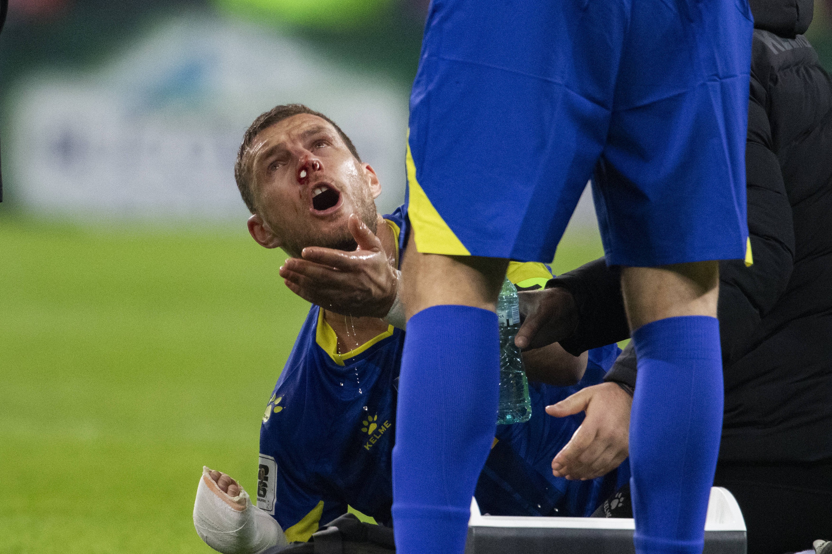 11 Edin Džeko with nose bleading