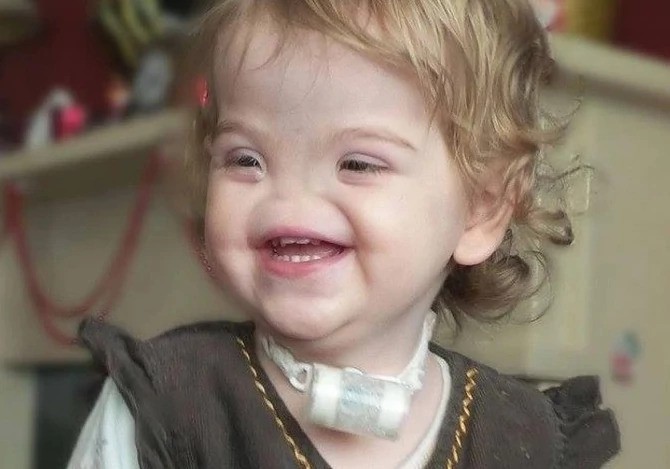 Devojčica rođena bez nosa