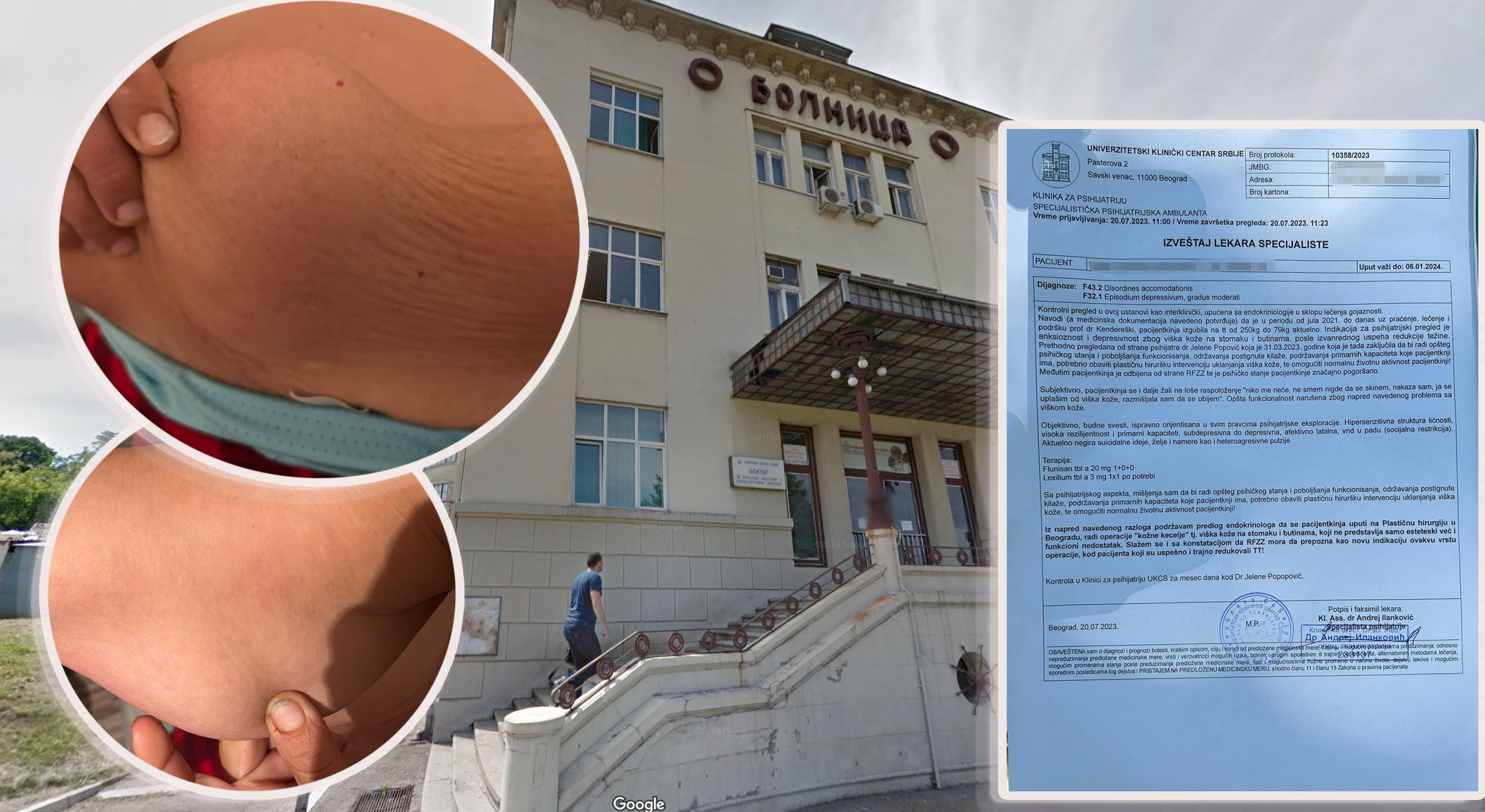 tema: Žena imala 190 kilograma, smršala 100 i sad ima problem sa viškom kože koji joj ugrožava zdravlje i život, dobila odobrenje Fonda, ali Klnika za opekotine odbija da je operiše
