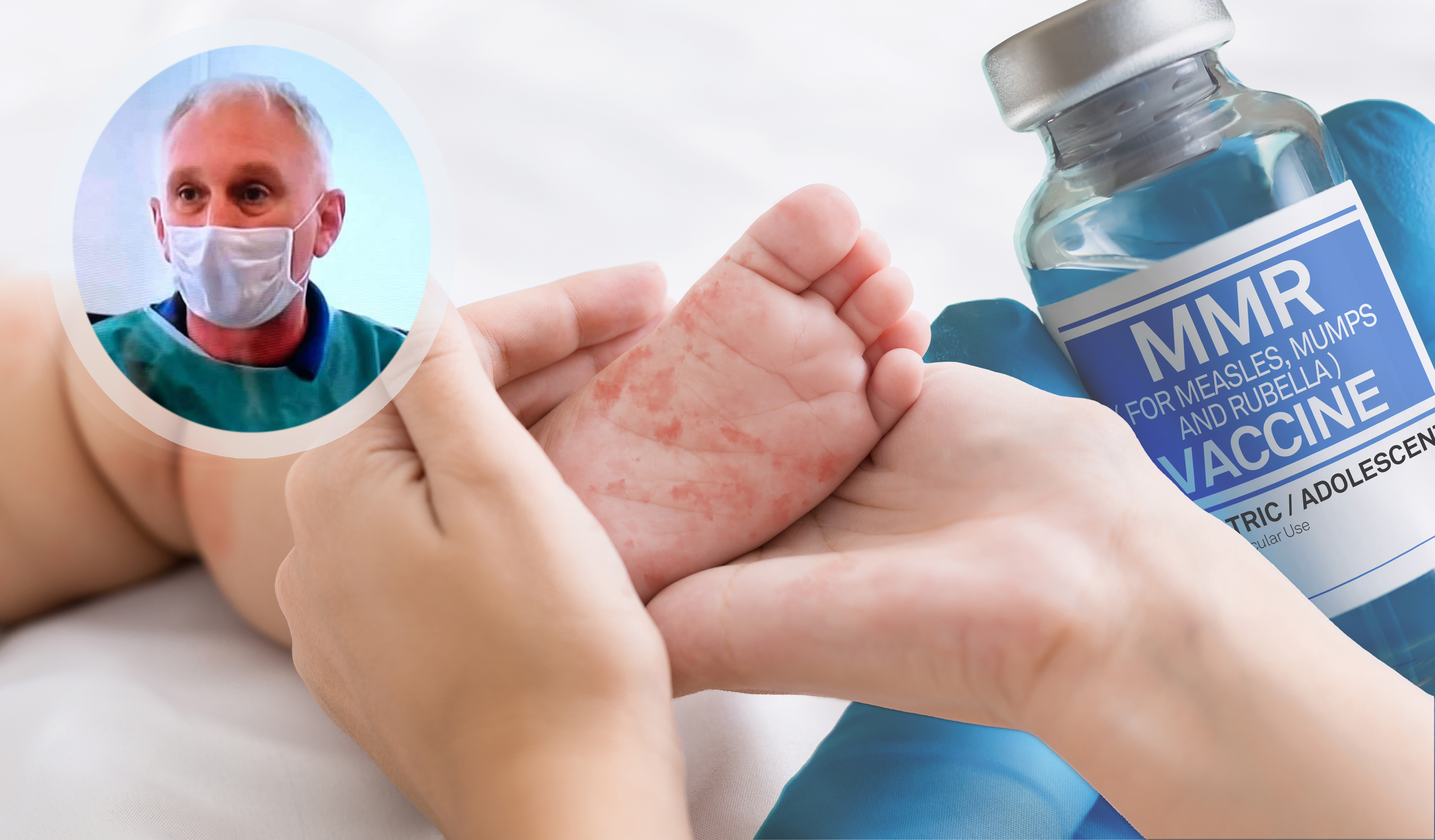 Lekari iz Novog Pazara, opštine sa najmanje vakcinisane dece u Srbiji, prijavljuju nesavesne roditelje, ali nadležni ne reaguju  Measles virus. Mother holding tiny baby foot with red rash, closeup