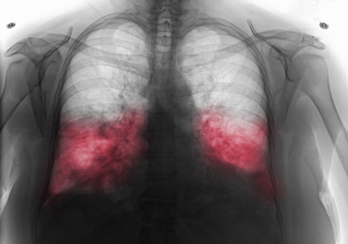 chest x-ray showing bilateral pneumonia