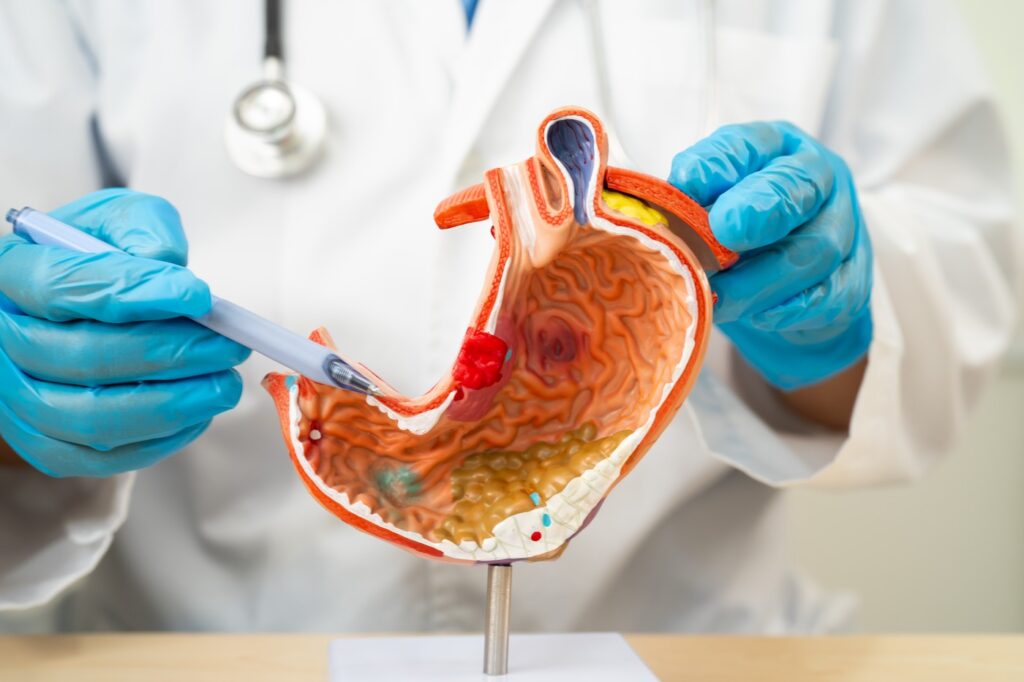 Dyspepsia or gastric disease,  doctor holding stomach anatomy model for study  diagnosis and treatment in hospital.,Image: 910276924, License: Royalty-free, Restrictions: , Model Release: no, Credit line: Pakawadee Wongjinda / Panthermedia / Profimedia
