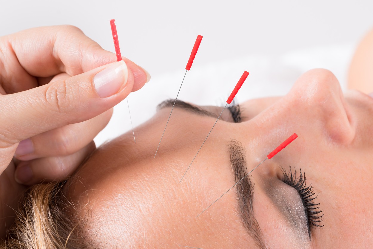 Closeup of hand performing acupuncture therapy on head at salon,Image: 801166870, License: Royalty-free, Restrictions: , Model Release: yes, Credit line: Andriy Popov / Panthermedia / Profimedia