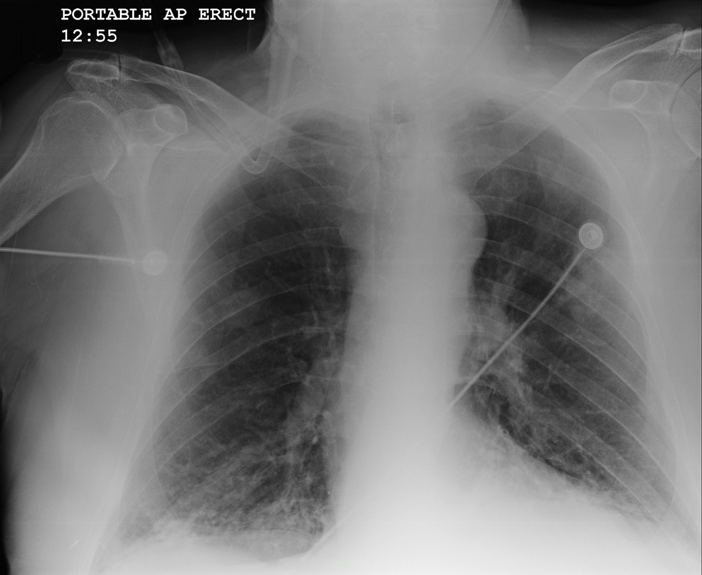 X-ray of chest showing COPD