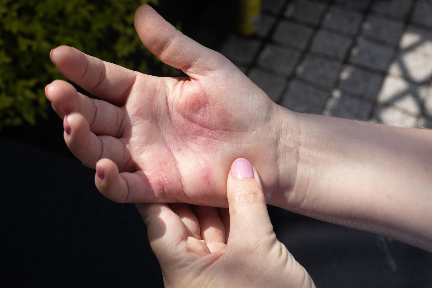 Severe allergic eczema on the hands. Red, cracked skin with blisters. Woman is scratching her hand