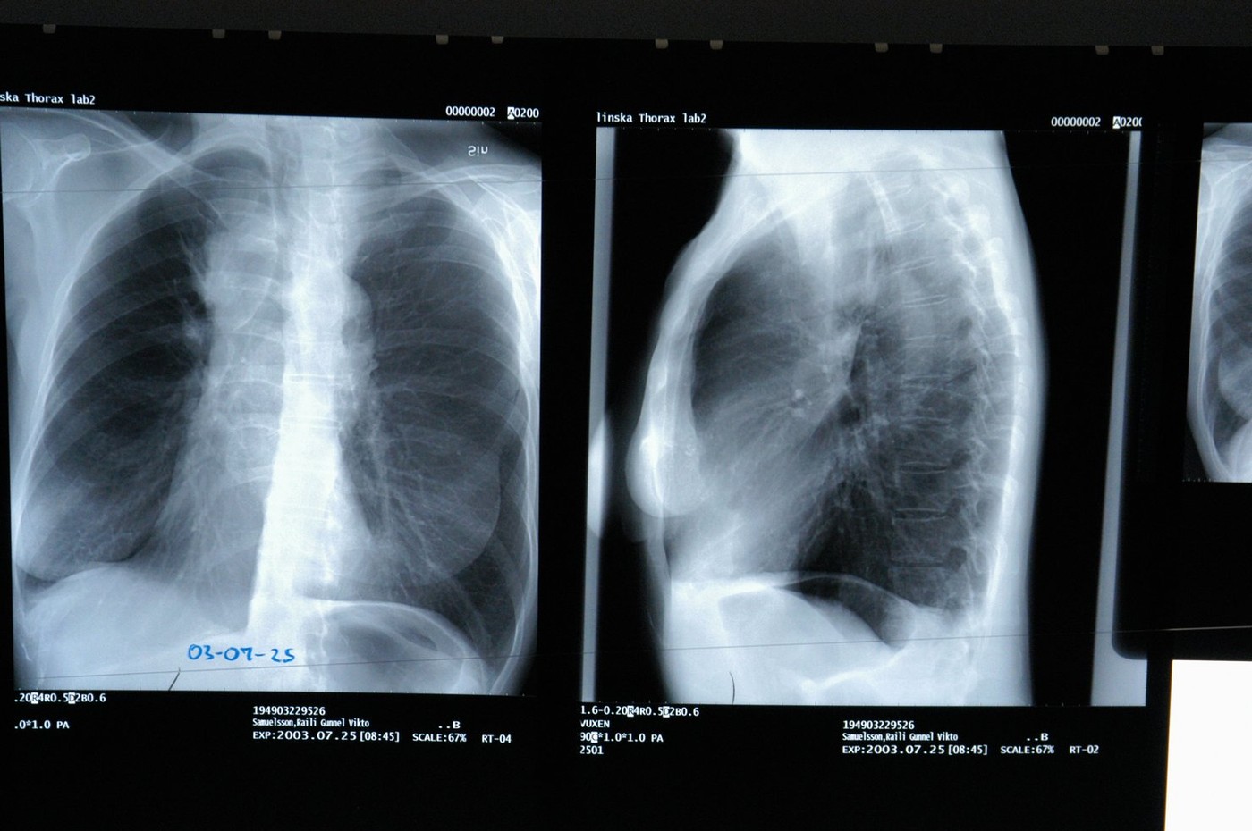 x-ray plate of human lungs, screening lung cancer,Image: 8748041, License: Royalty-free, Restrictions: , Model Release: no, Credit line: Deco Images / Alamy / Alamy / Profimedia
