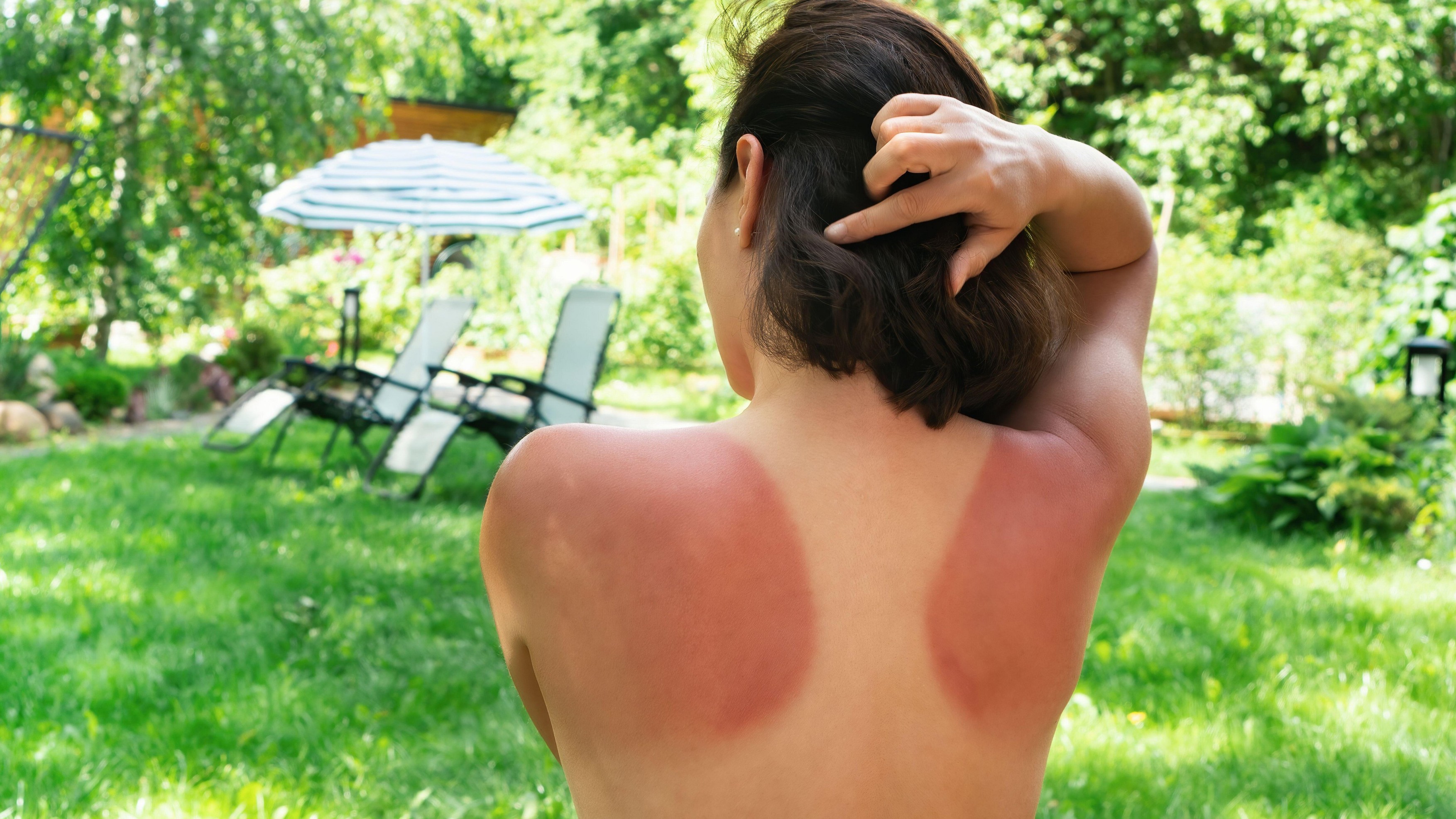 Sunburned skin of a girl. Red prints from a sunburn. The woman burned her skin because she did not use SPF protection from solar ultraviolet radiation
