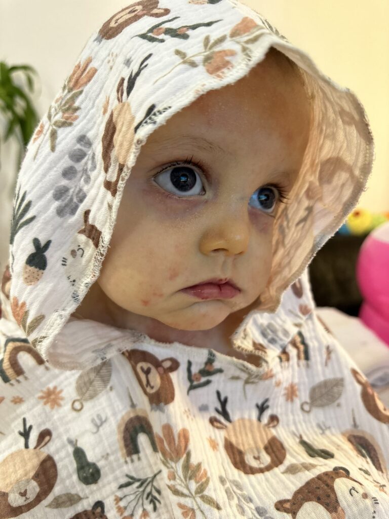 Viktora Putic Viktor je beba obolela od retkog genetskog obolenja zvanog bulozna epidermoliza, u javnosti poznatog kao bolest „dece leptira“.