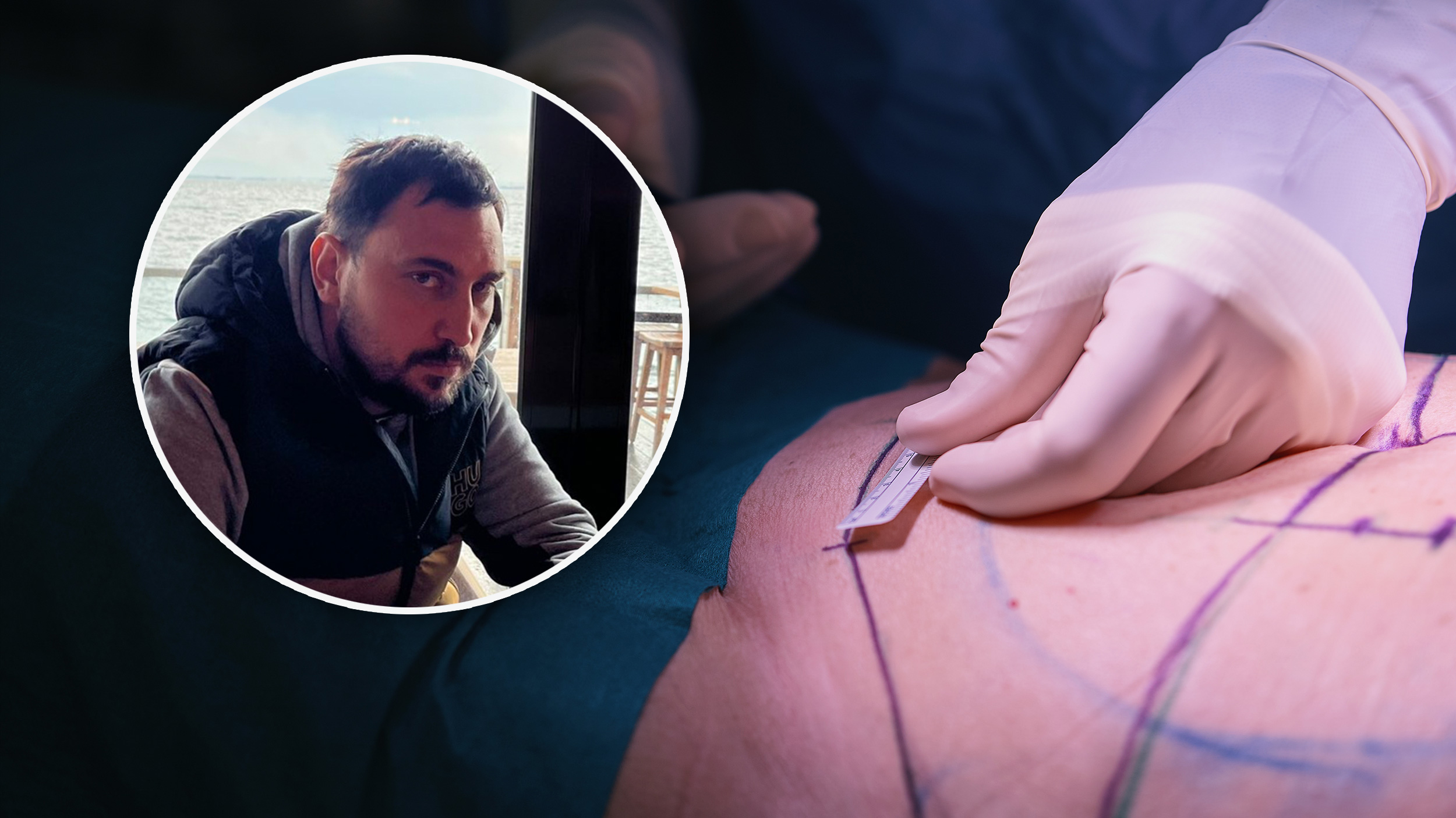 Aleksandar Sič,  operacija stomaka
Aleksandar otišao na operaciju zatezanja stomaka, a lekari mu uništili život, rana gnoji i curi gotovo 12 meseci