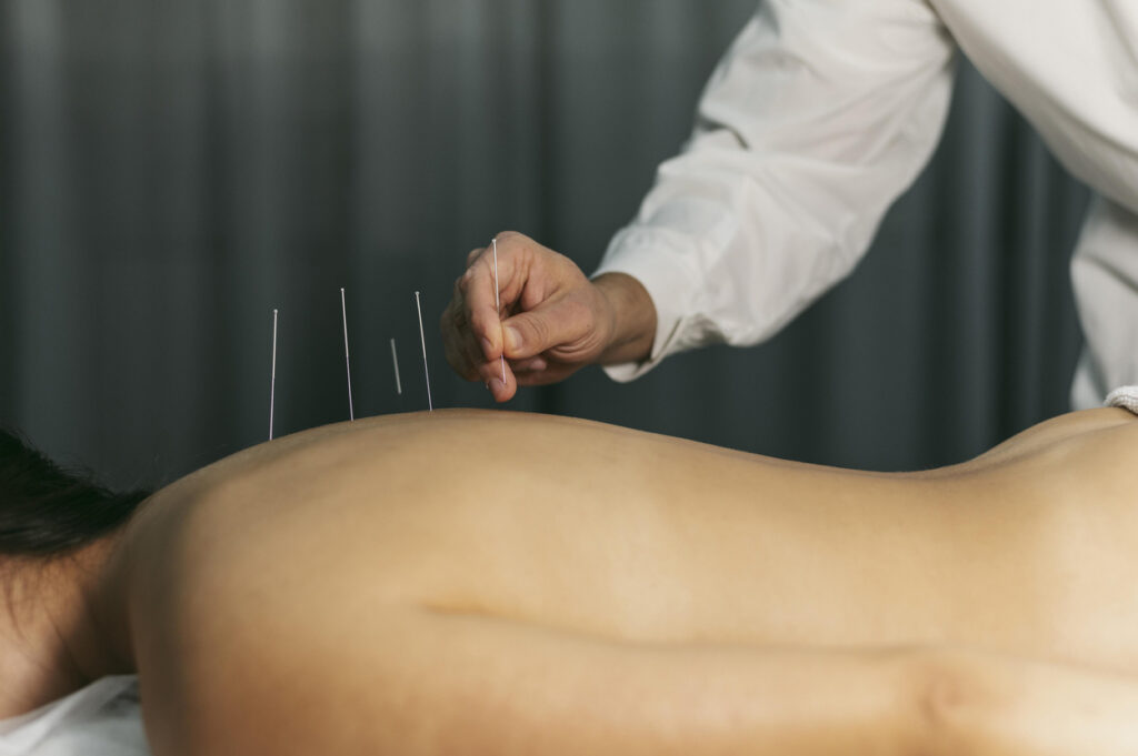 Acupuncture process. Resolution and high quality beautiful photo,Image: 792984579, License: Royalty-free, Restrictions: , Model Release: yes, Credit line: Oleksandr Latkun / imageBROKER / Profimedia
