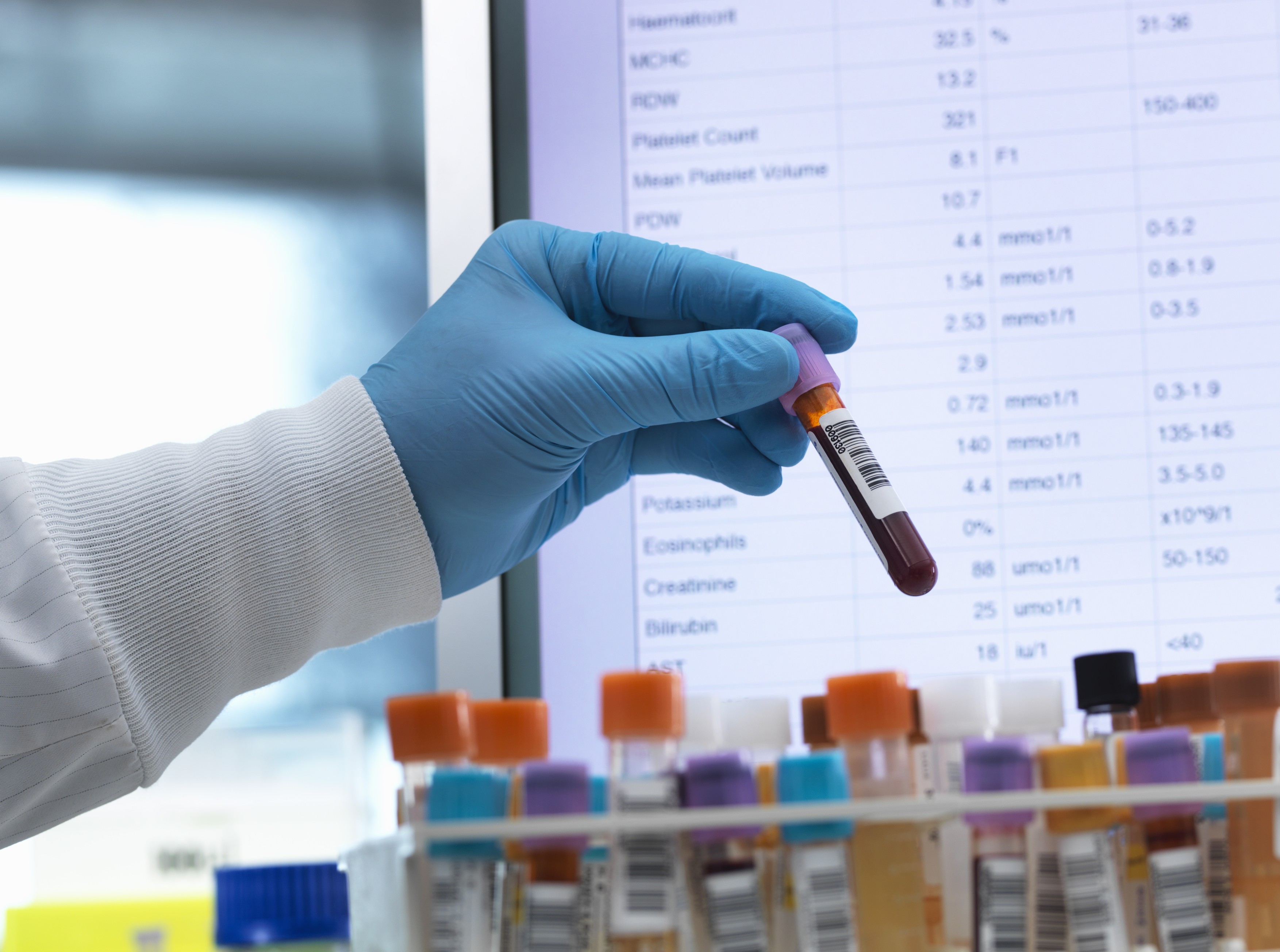 Blood analysis, Haematologist preparing medical samples including blood for testing with results on the computer screen