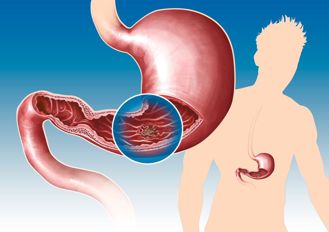 GASTRIC ULCER, DRAWING
