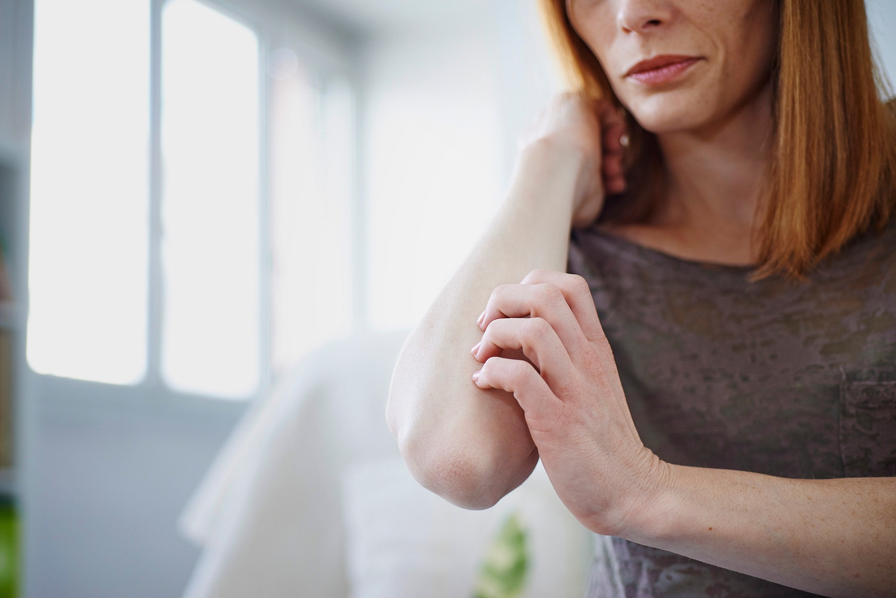 Woman scratching her elbow.,Image: 249096163, License: Rights-managed, Restrictions: , Model Release: yes, Credit line: Alice S. / BSIP / BSIP / Profimedia