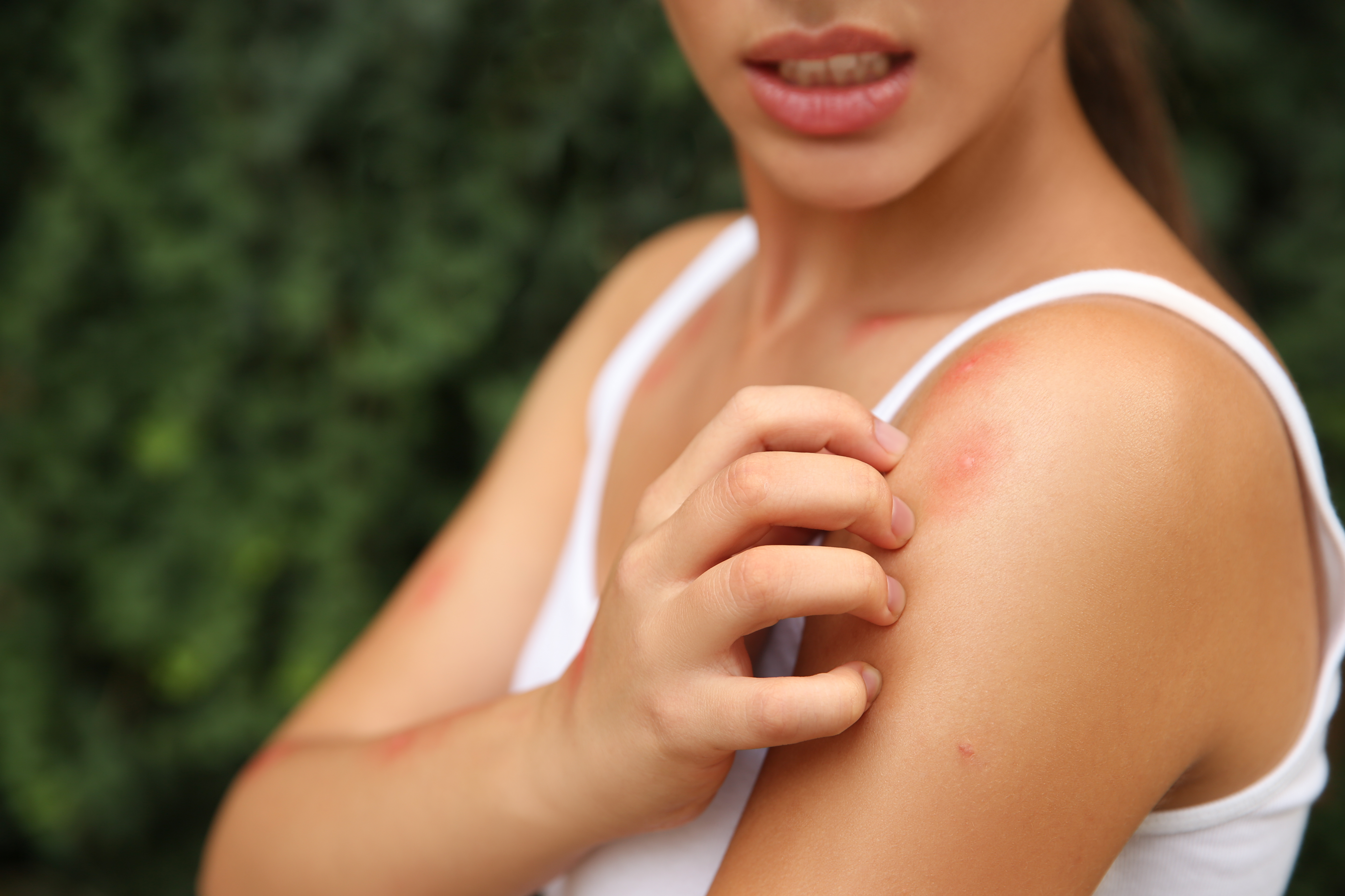 Woman,Scratching,Shoulder,With,Insect,Bite,Outdoors,,Closeup