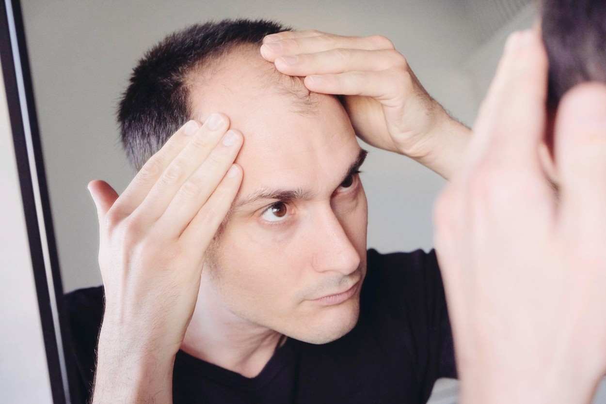 Young man looking at mirror worry about balding.