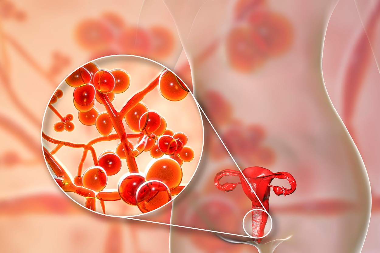Candida auris infection in female, illustration