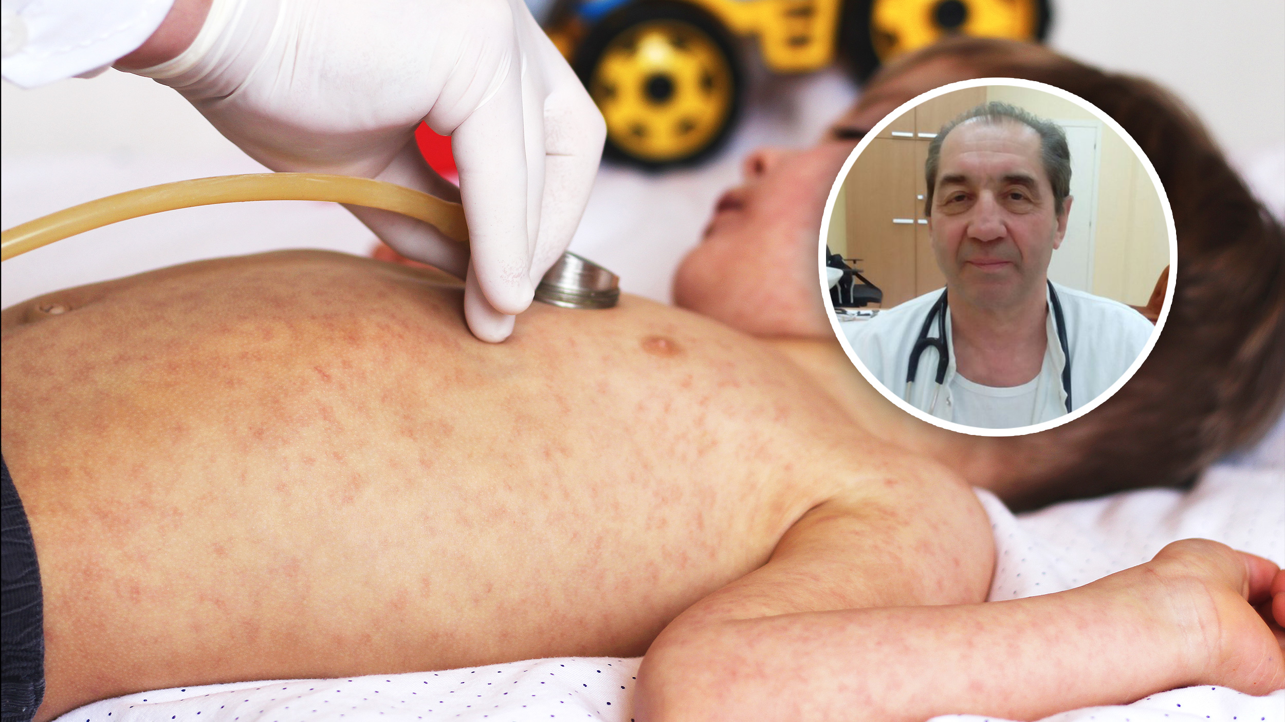 Pedijatar Slavko Dušanov, Morbili