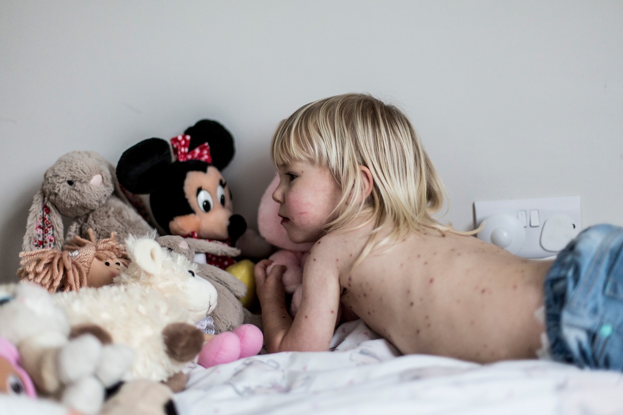 Girl with chickenpox