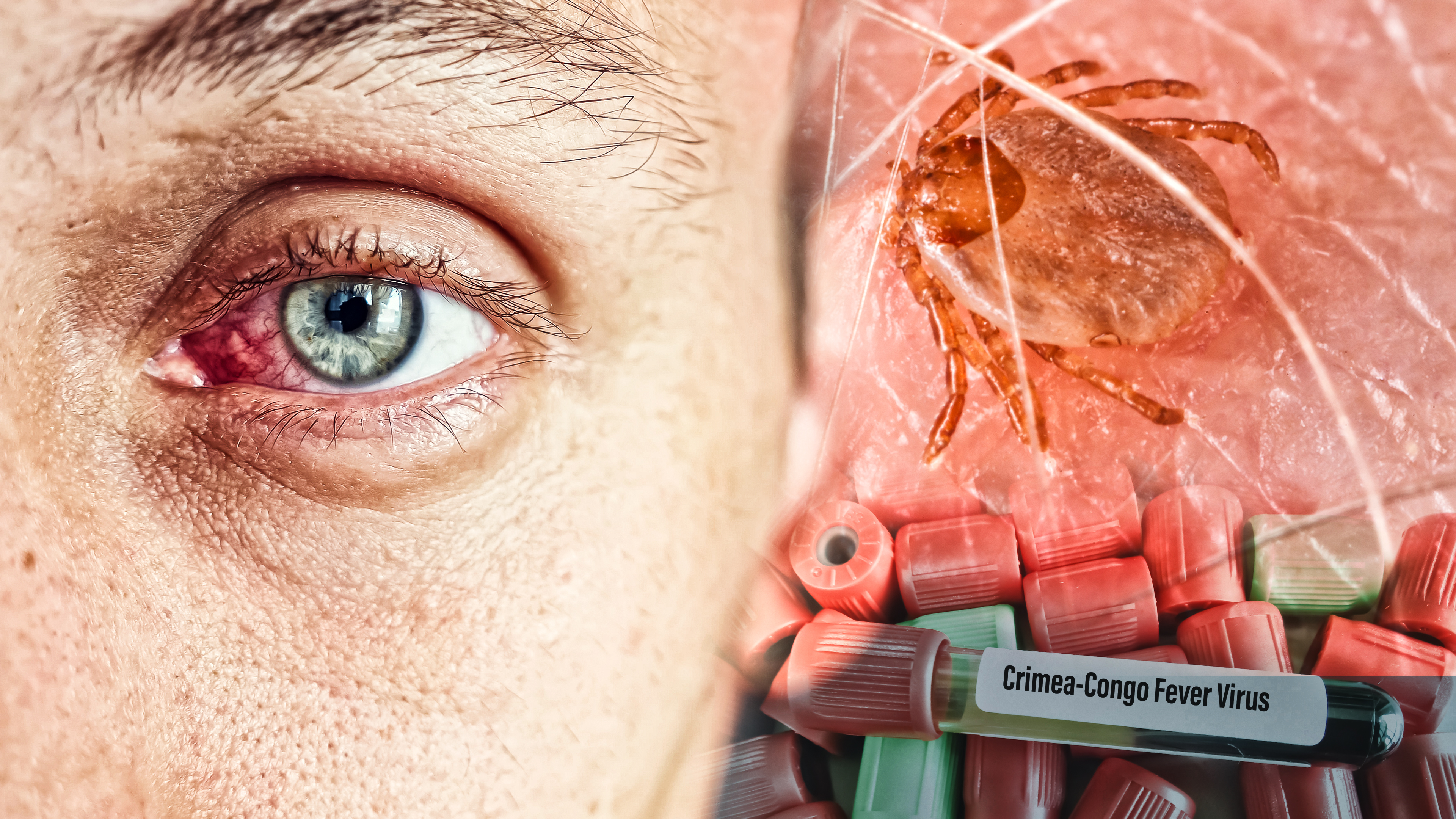 krpelj za Spasu Close up of the red eye of a man affected by an infection, copy space