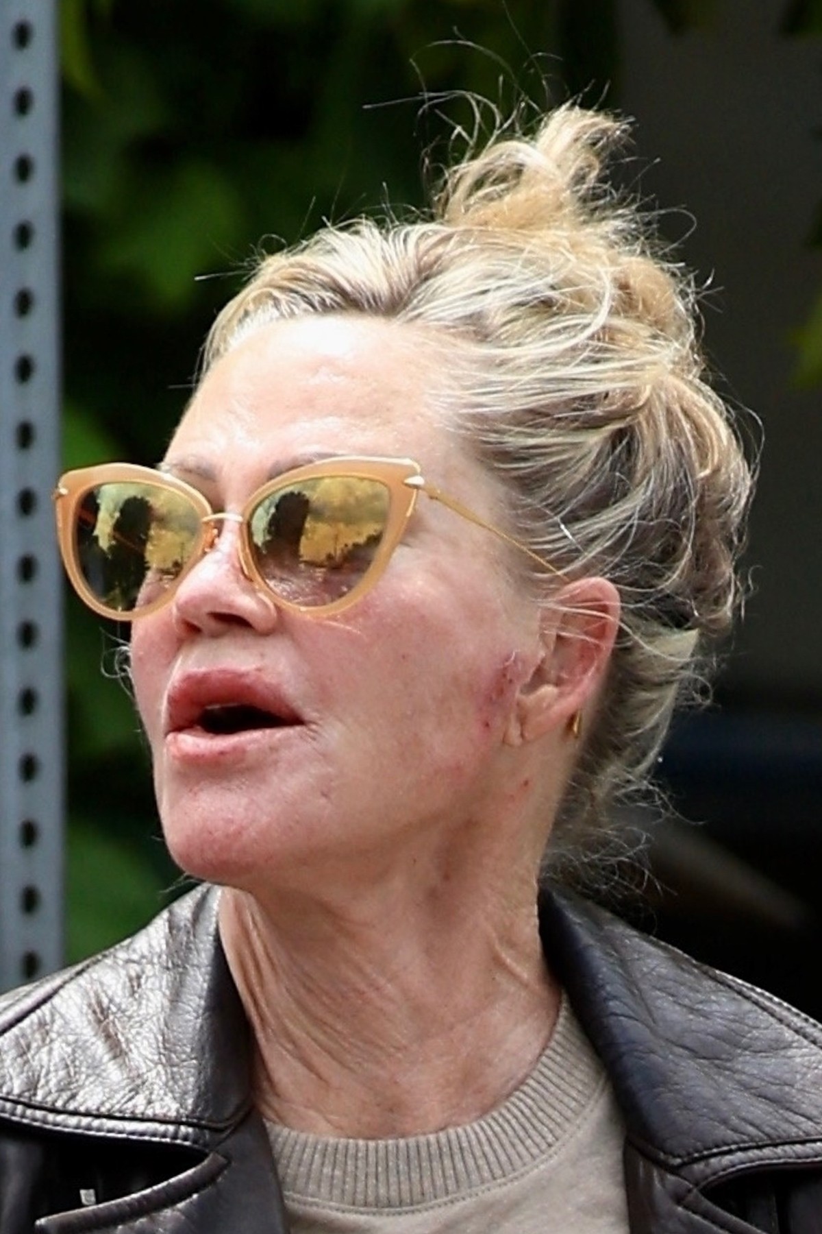 *EXCLUSIVE* Melanie Griffith displays a couple of bruises on her face and hands