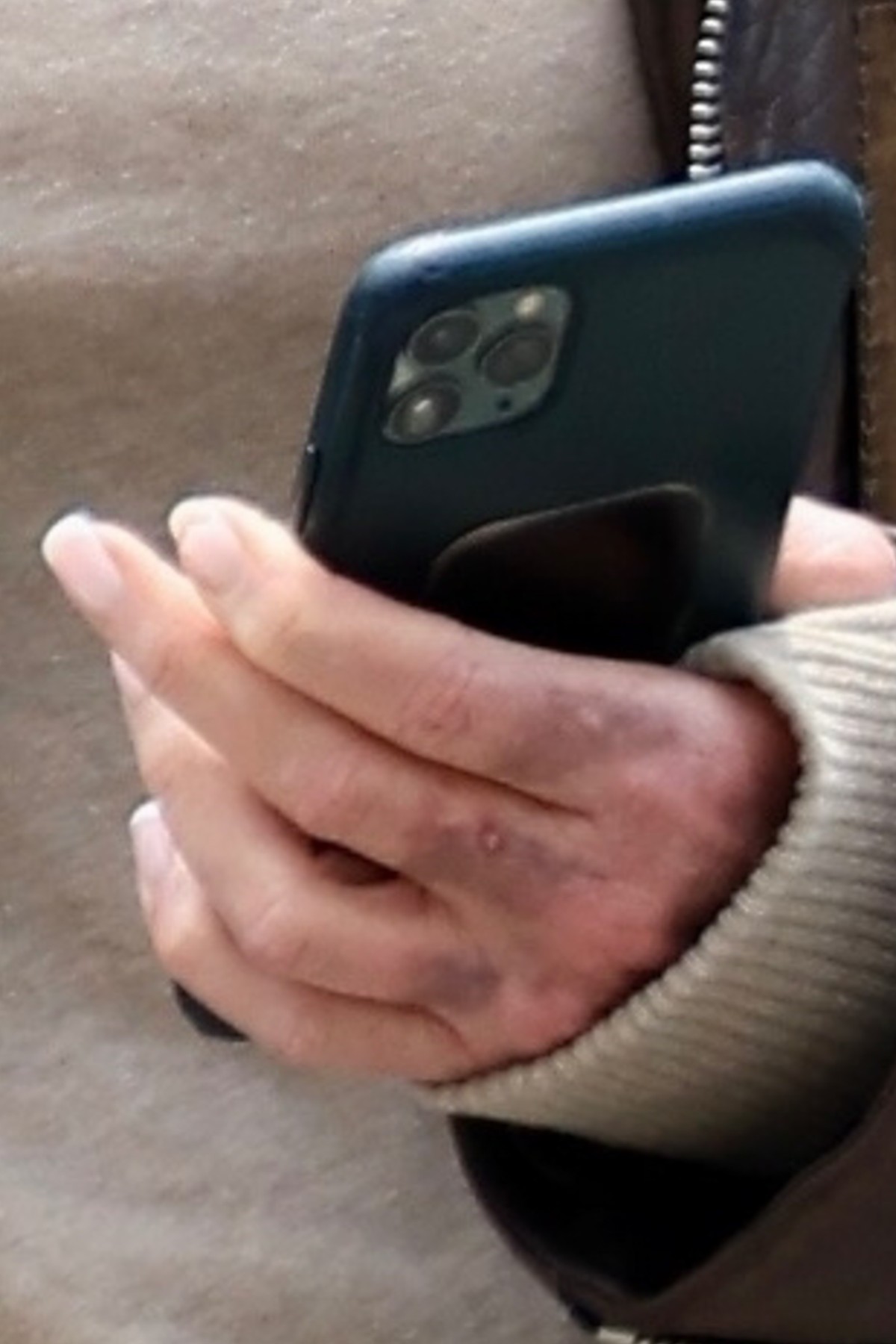 *EXCLUSIVE* Melanie Griffith displays a couple of bruises on her face and hands