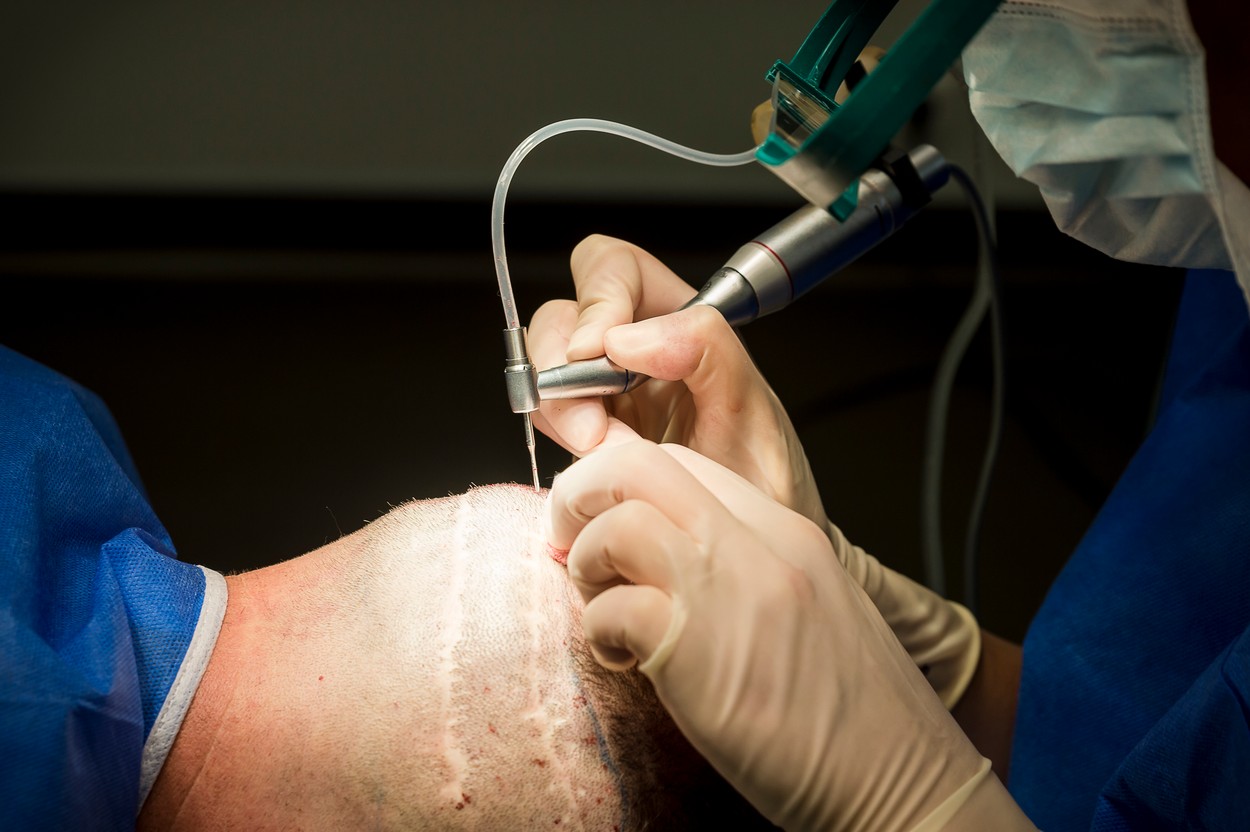 Hair transplantation