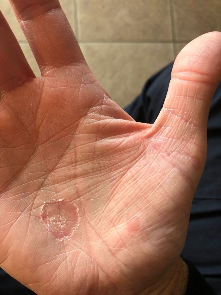 rok trajanja kozmetika, nus pijave opekotine rane