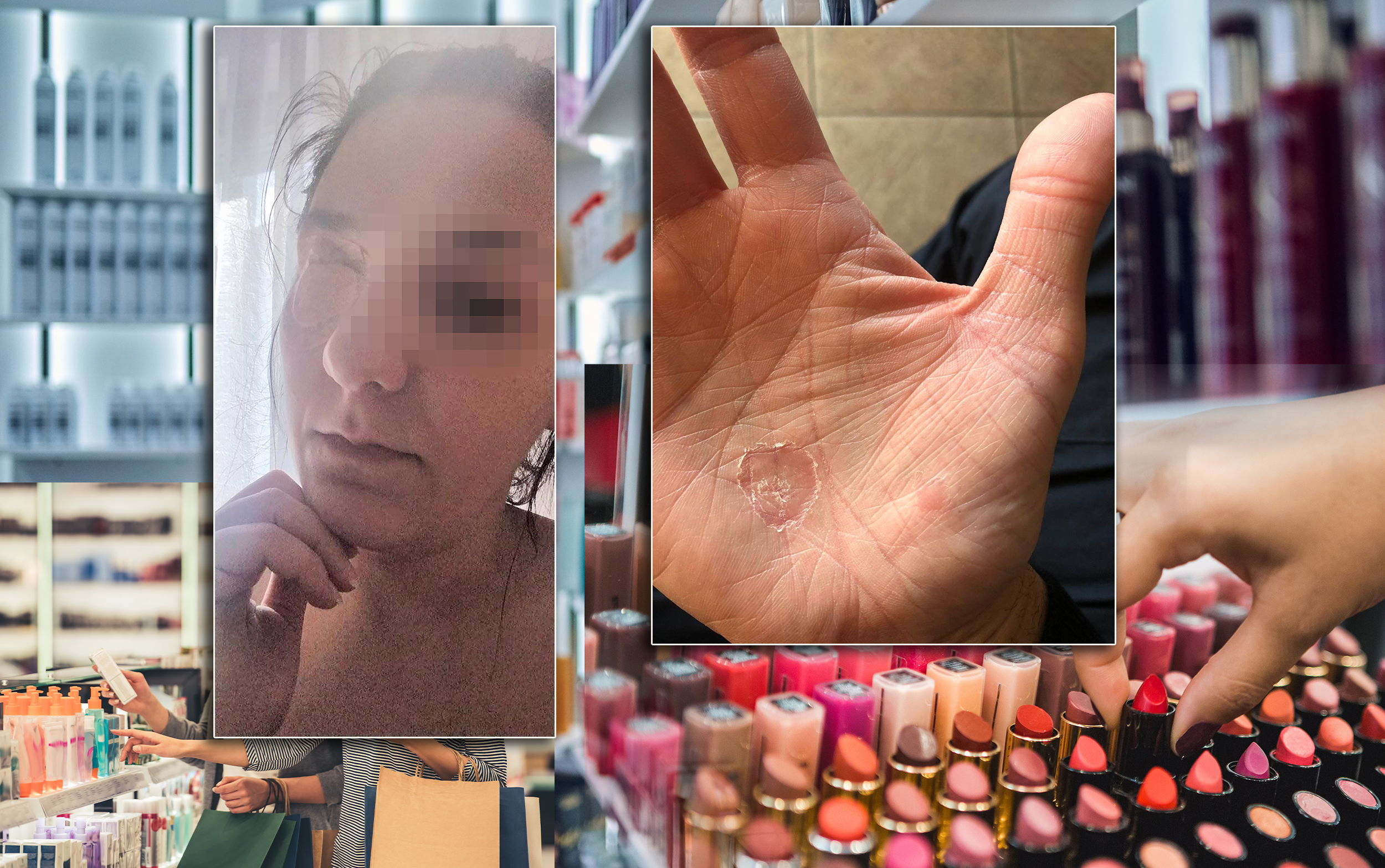 rok trajanja kozmetika, nus pijave opekotine rane