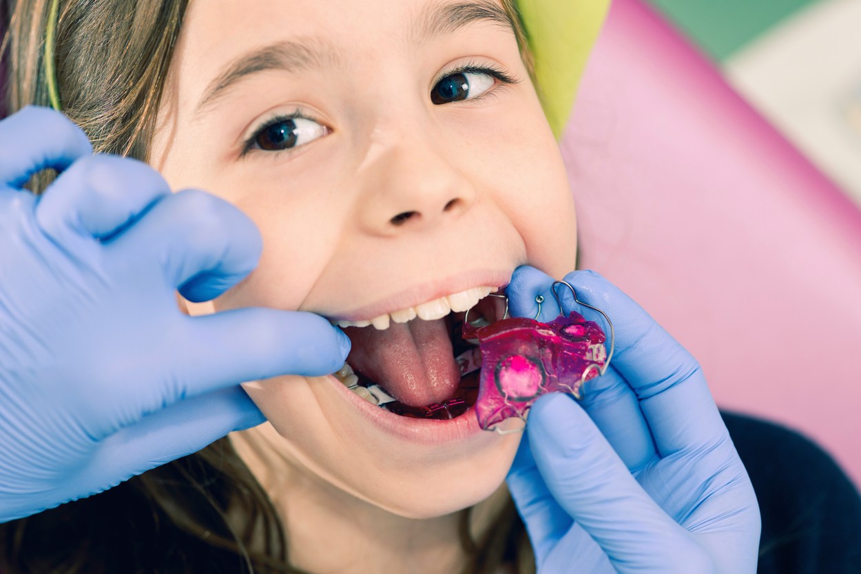 Dental braces.,Image: 423884920, License: Royalty-free, Restrictions: Model Released
29675, Model Release: yes, Credit line: MICROGEN IMAGES / Sciencephoto / Profimedia