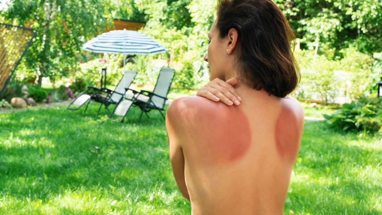 Sunburned skin without uv protection. Girl with sunburn on the background of sun loungers and a beach umbrella. Red marks on the skin of the back from