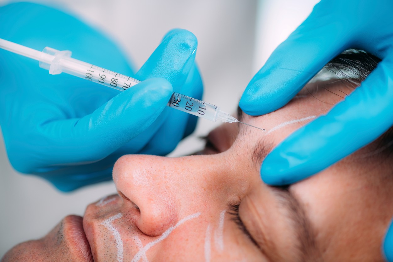 Dermal filler injection for men