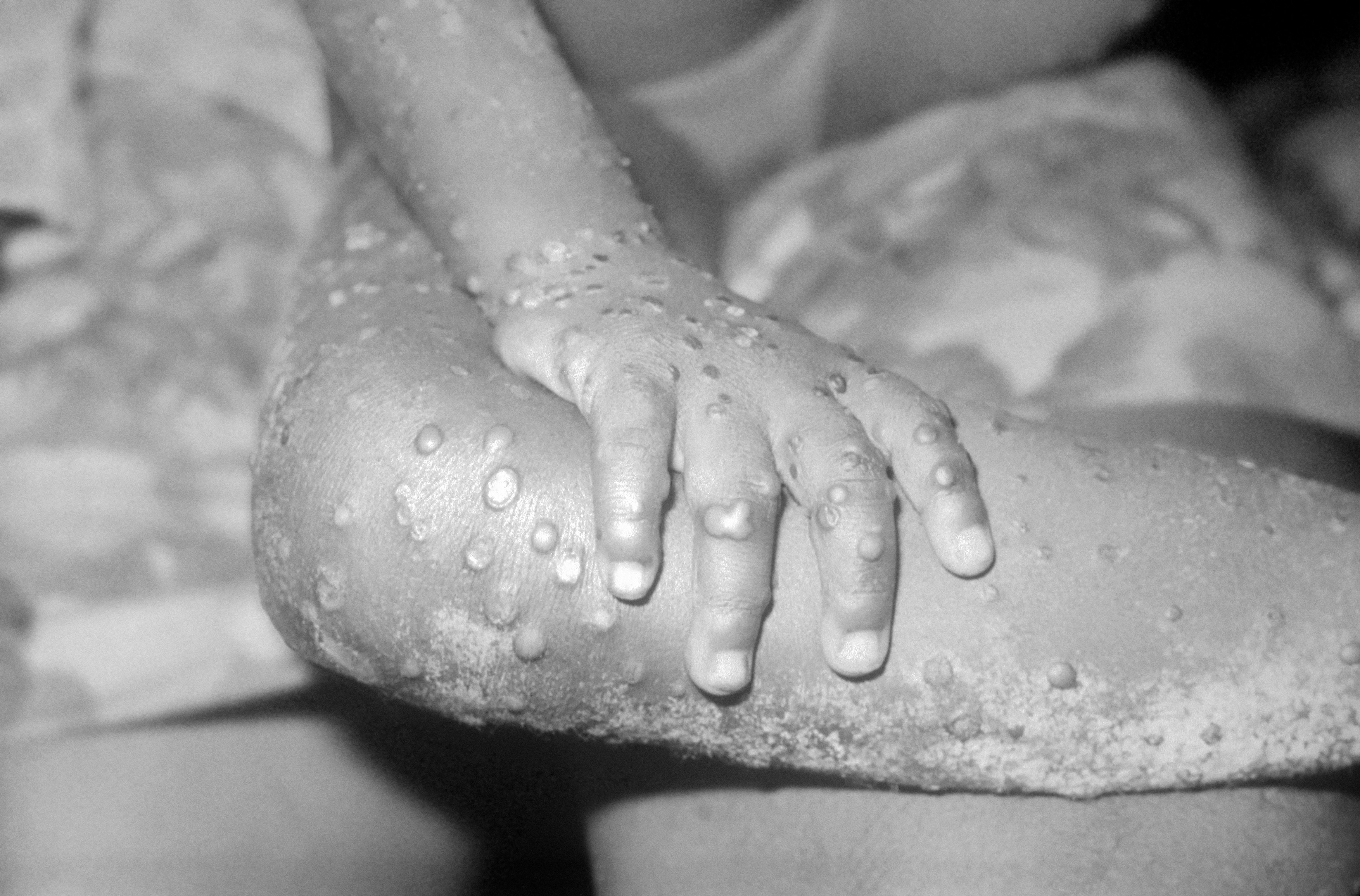 Monkeypox infection, 1971