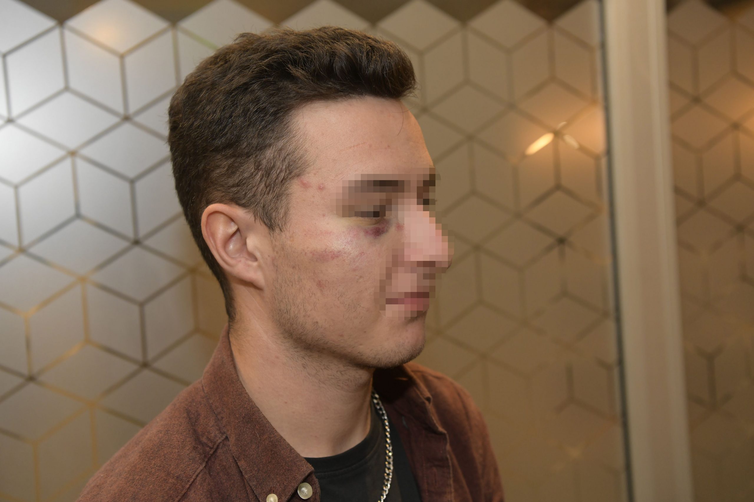 Beograd 17. oktobar 2022. Pretuceni Svajcarci na splavu Kafana na vodi. Svajcarski drzavljani pretuceni u nocnom izlasku prilikom poseti Beogradu, medicinska dokumentacija iz Urgentnog centra Foto:Goran Srdanov