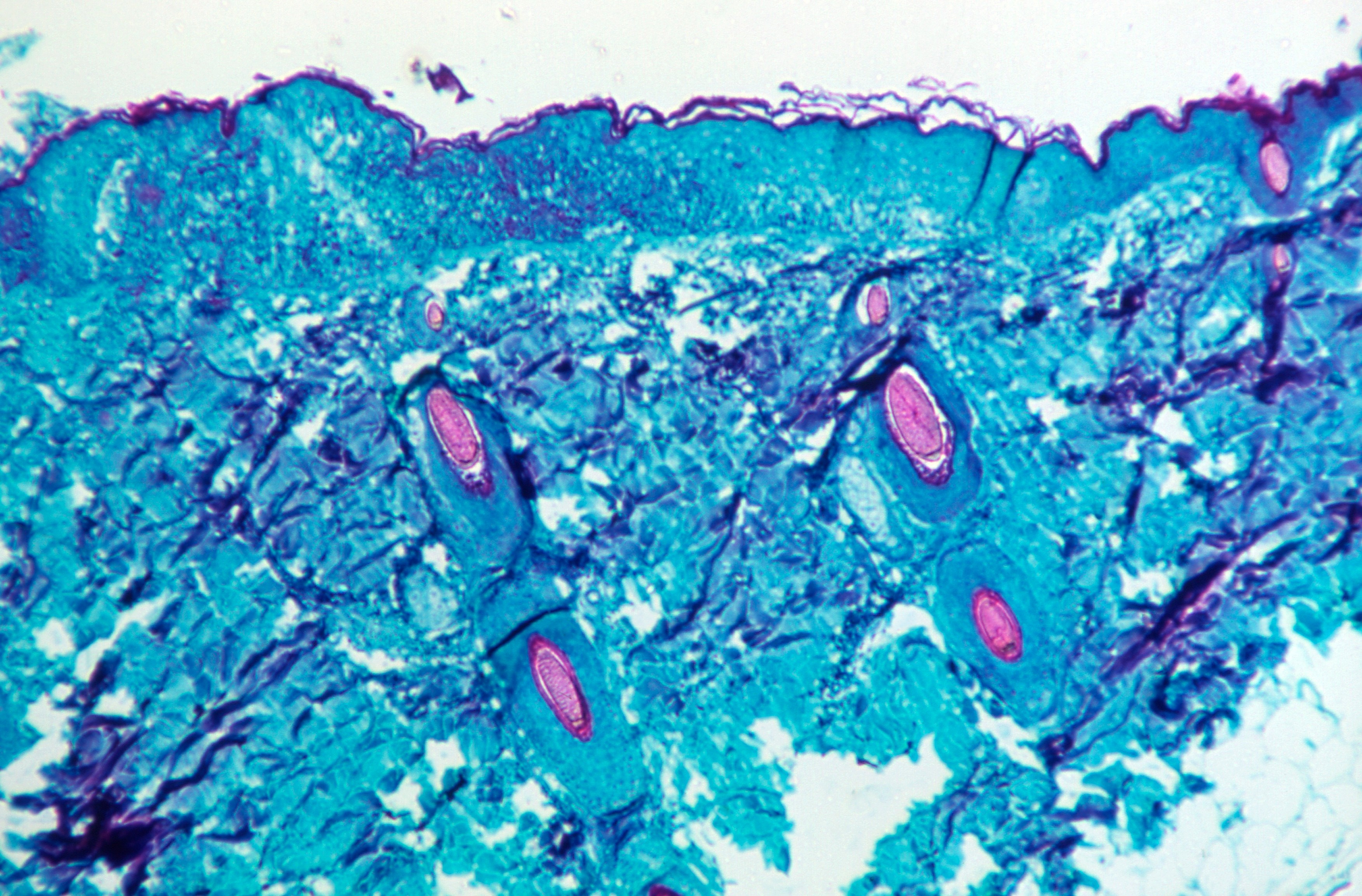Monkey skin tissue infected with monkeypox virus
