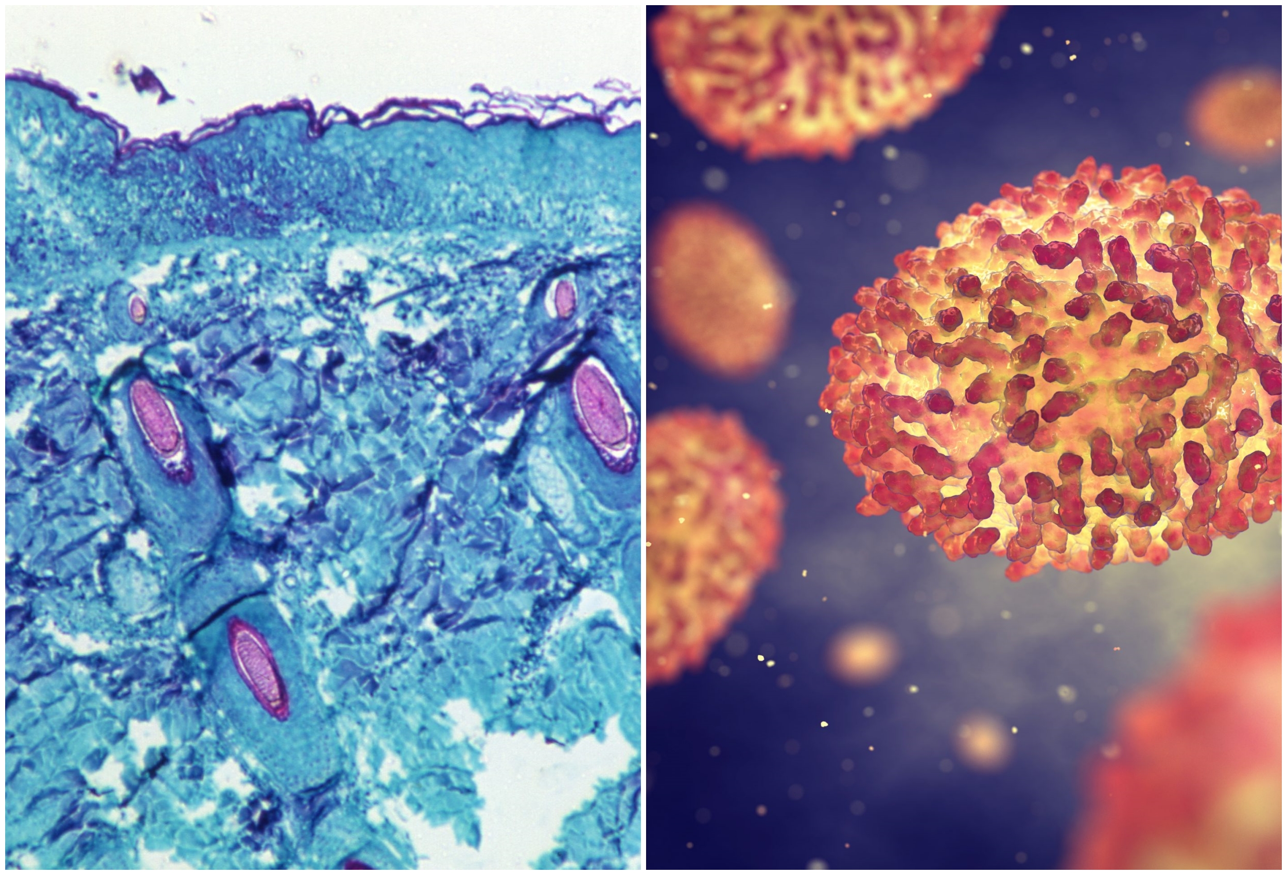 Majmunske Boginje i Variola Vera kombo kombo