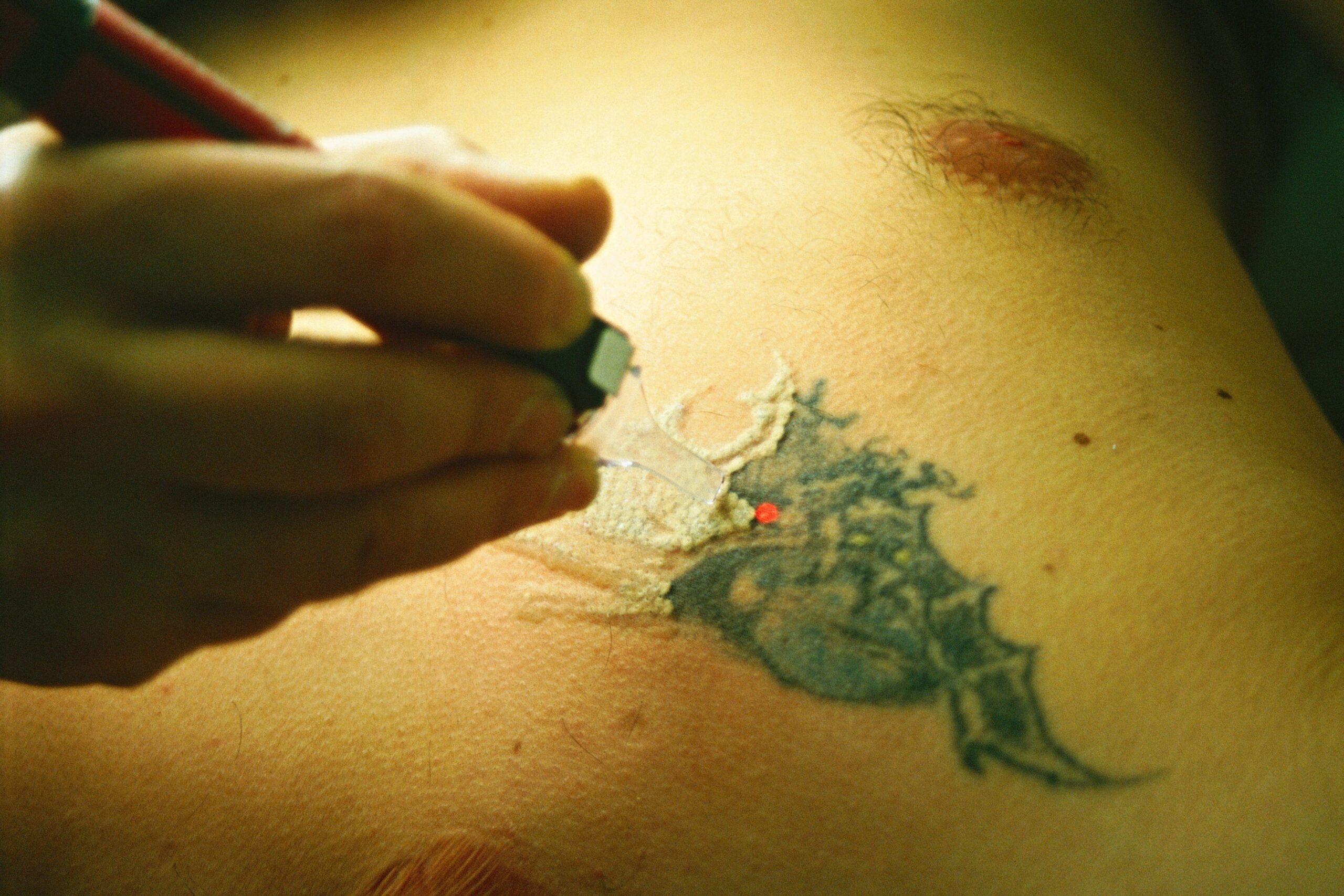 Photo essay. Laser center. Dermatology.,Image: 41278150, License: Rights-managed, Restrictions: , Model Release: yes, Credit line: LAURENT / BSIP / Profimedia