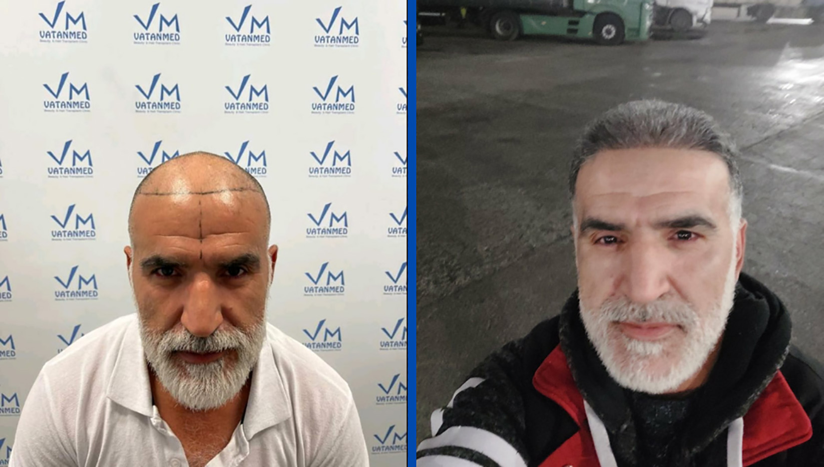 Vatanmed, presađivanje, presadjivanje kose, kosa, PR tekst Foto: Promo