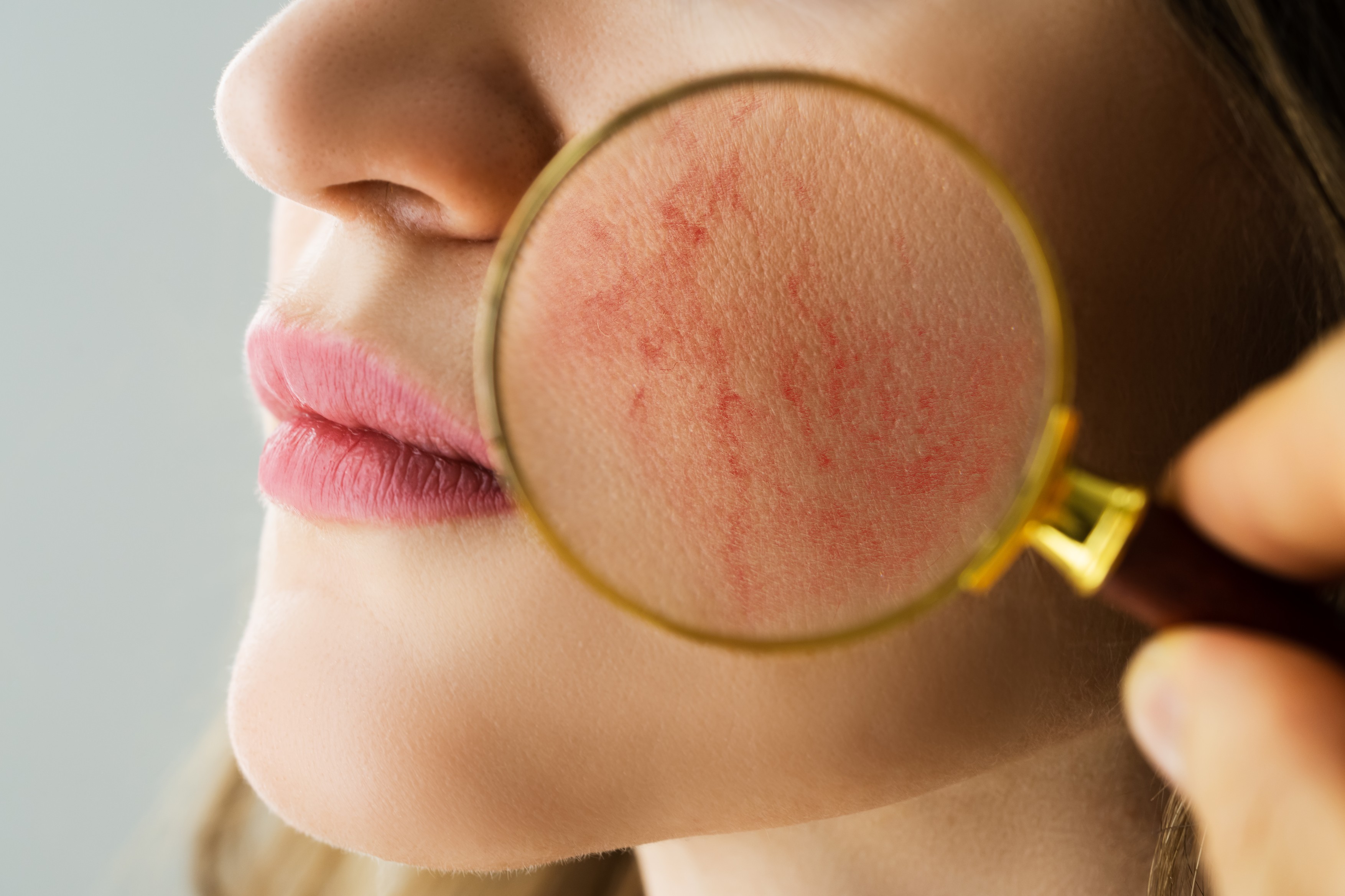 Rosacea Face Skin Problem And Aesthetic Treatment,Image: 584210412, License: Royalty-free, Restrictions: , Model Release: yes, Credit line: Andriy Popov / Panthermedia / Profimedia