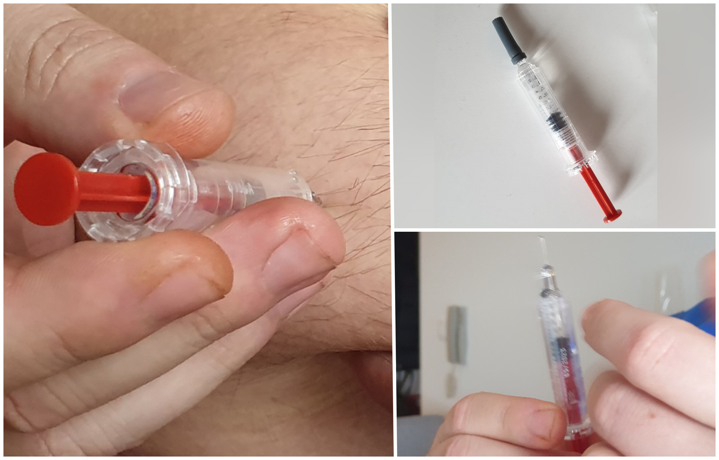 injekcije protiv zgrušavanja krvi tokom korone fraksiparin fraxiparin